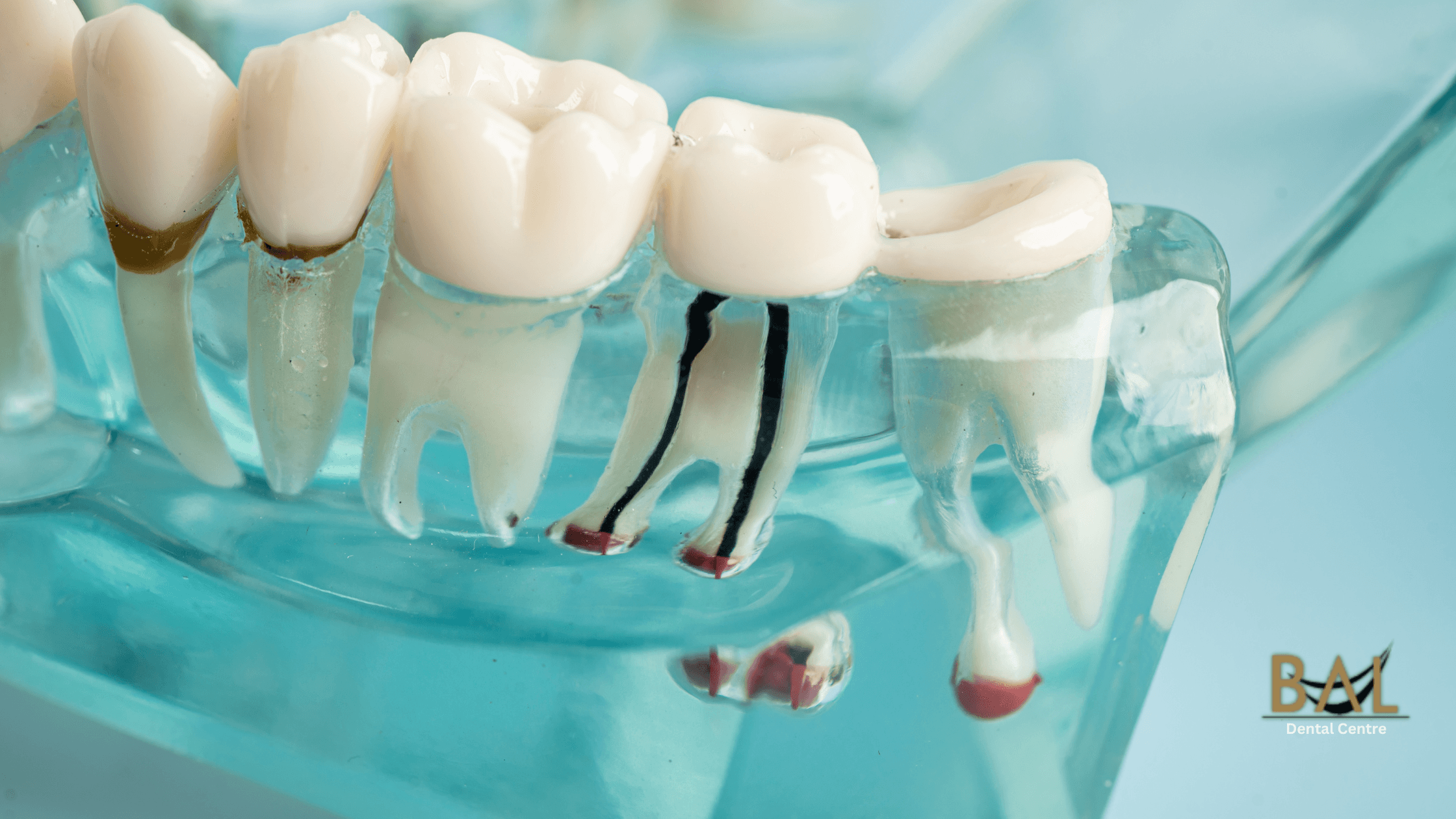 Can Preventive Dentistry Help Avoid Root Canals