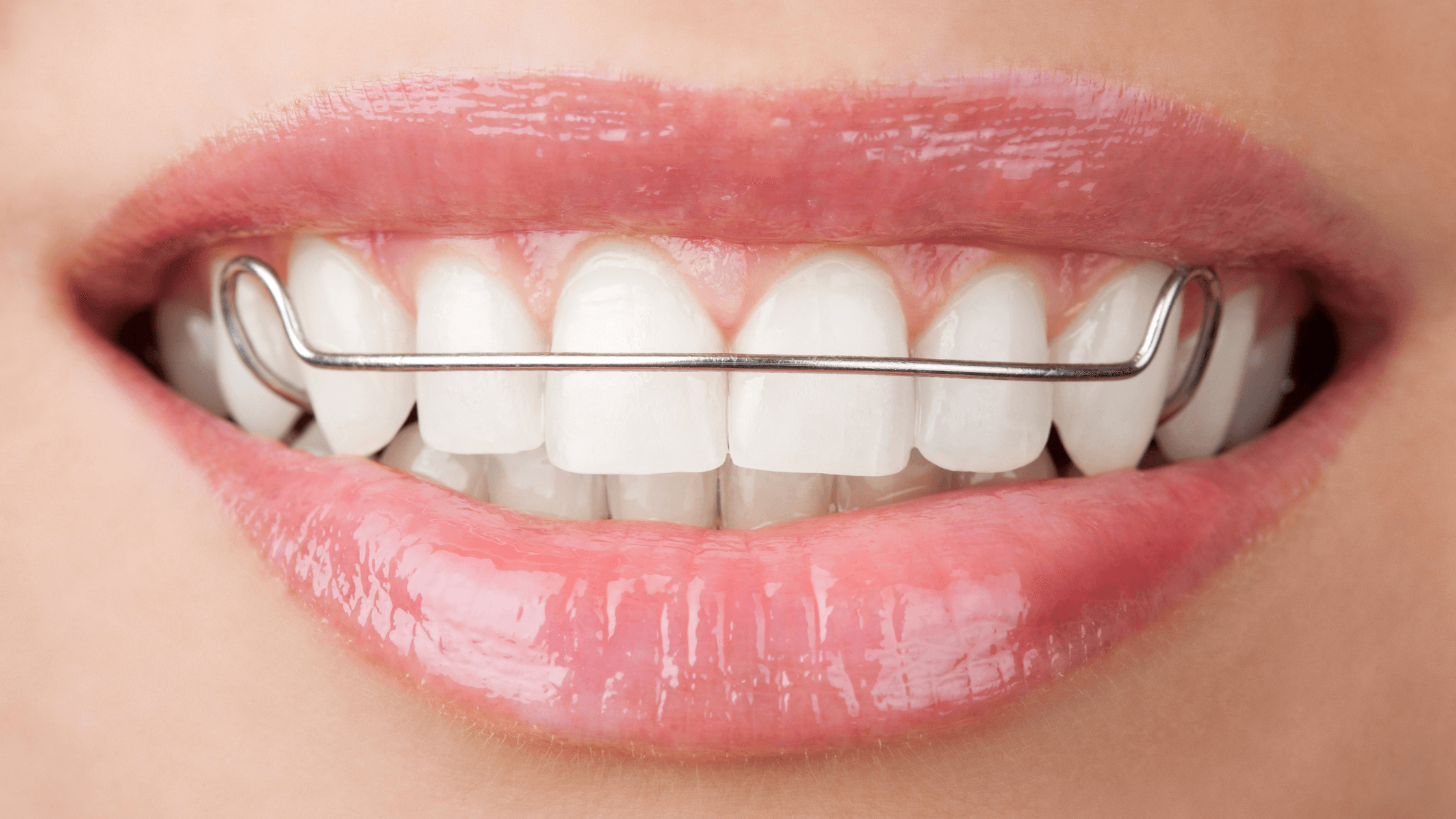 The Importance of Retainers After Invisalign Treatment